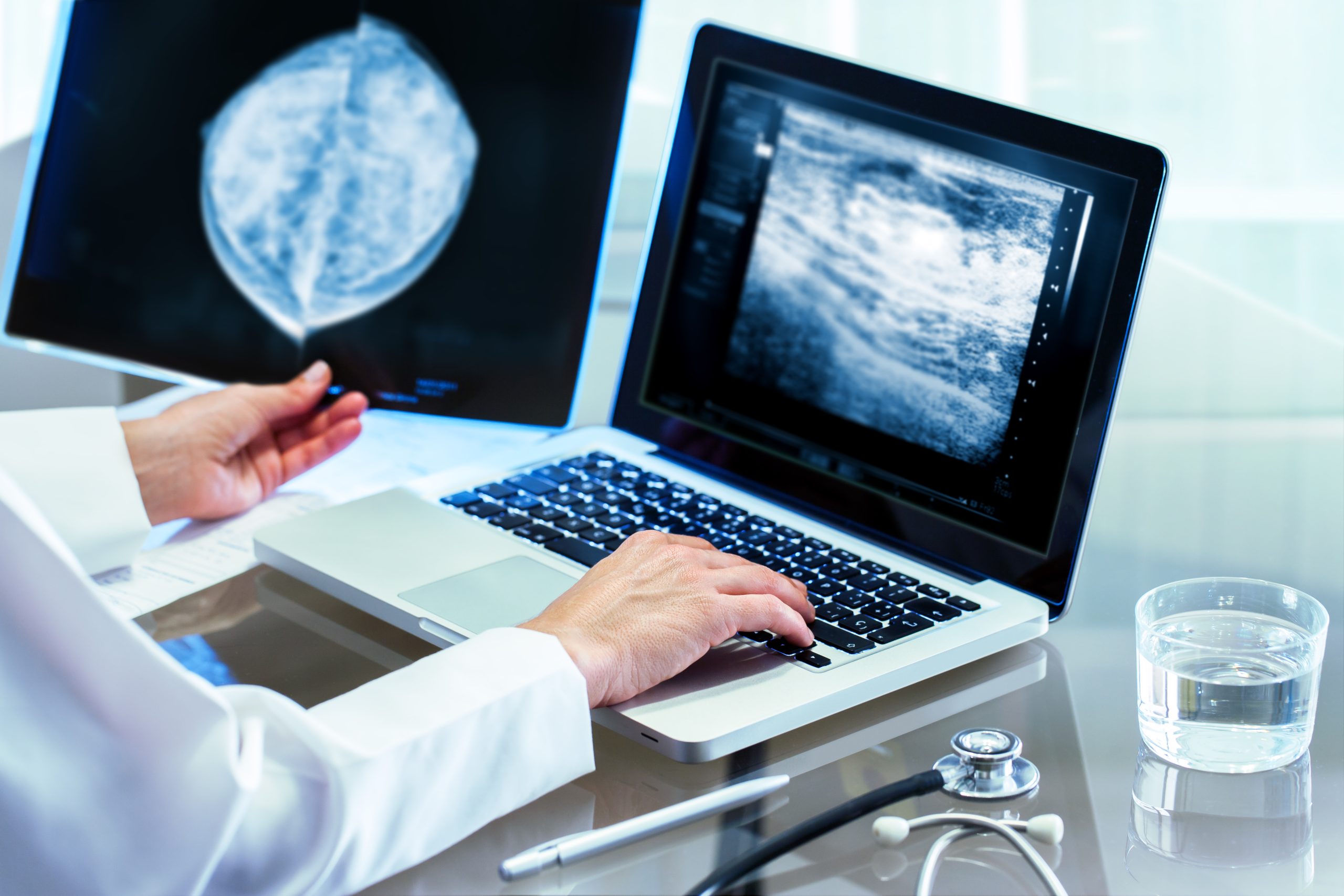 Mammographie-Screening senkt Brustkrebssterblichkeit